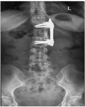 Fig. 1. Posteroanterior (PA) lumbar x-ray radiograph showing internal fix- fix-ation between the left side of the T12 and L2 vertebrae.