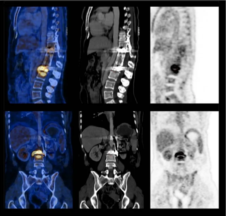 Fig. 2. Sagittal and coronal slices of fluorodeoxyglucose (FDG) positron emission tomography combined with computed tomography (PET/CT) images