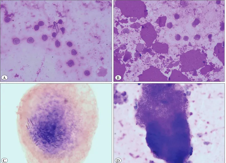 Figure 4:  A) Hook structure in cyst fluid (May Grunwald Giemsa, x10). B) Degenerated membrane structures in cyst fluid (May  Grunwald Giemsa, x20)