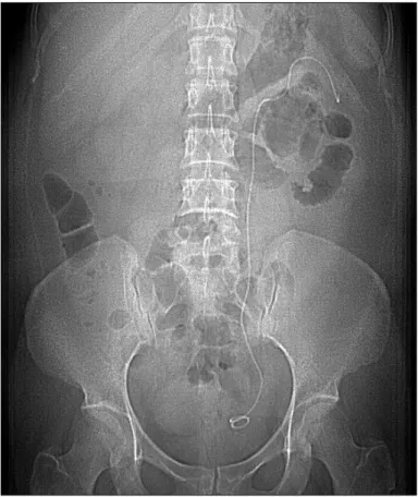 Figure 2. a, b. The course of ureteral DJ stent inside  the renal parenchyma