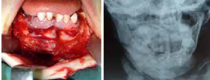 Figure  2.  Left;	 Two	 resorbable	 plates	 for	 a	 parasymphysis	 and	 symphysis	fractures	of	the	mandible	in	a	4-year-old	patient.	Right;	