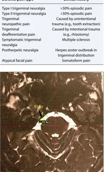 Fig. 1.  Gamma Knife plan. The target is the pars triangu- triangu-laris.