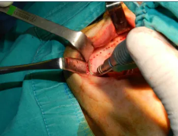 Figure 5: A 45° anterio-posteriorly angled osteotomy in the coronal plane.
