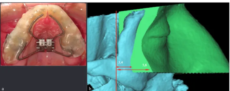 Figure 10:	(a)	A	3D	frontal,	oblique,	inferio-axial,	and	sagittal	view	of	a	new	soft	tissue	region	created	to	measure	anteroposterior	changes	in	the	malar	 region