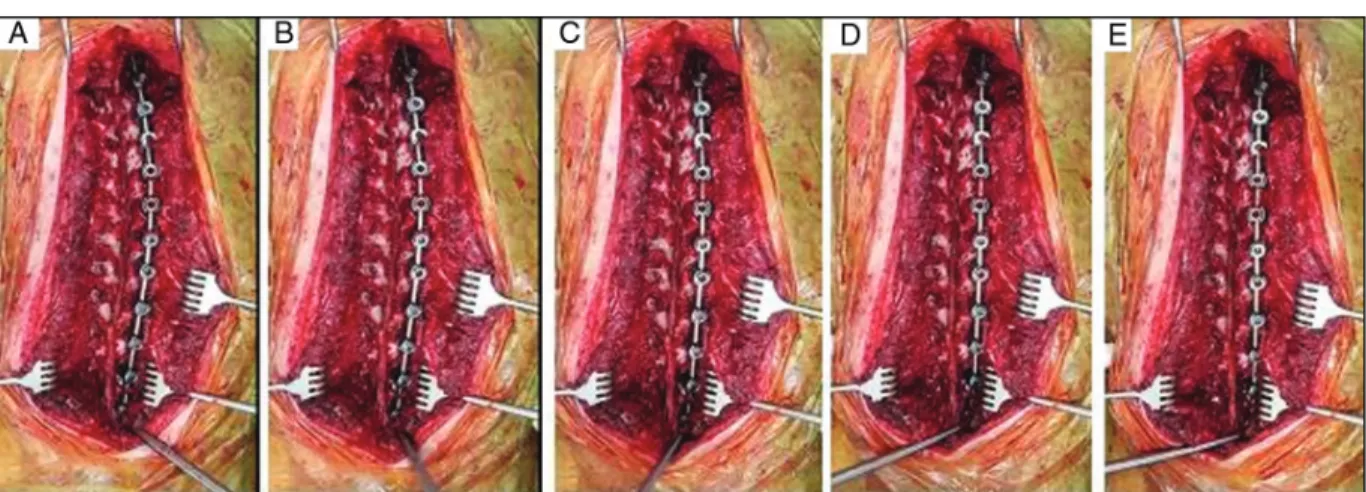 Figure 2: Perioperative views of UCRR technique (rotating the convex rod): From A to E we can see the rotation of the convex rod