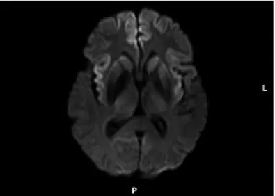 Figure 1.  Diffusion-weighted image of ribbon sign in bilateral  frontal and insular cortices
