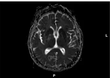 Figure 2.  Apparent diffusion coefficient (ADC) image of ribbon  sign in bilateral frontal and insular cortices