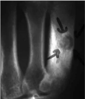 Figure 1. Plain radiograph of the first patient shows ni- ni-dus and surrounding sclerotic bone