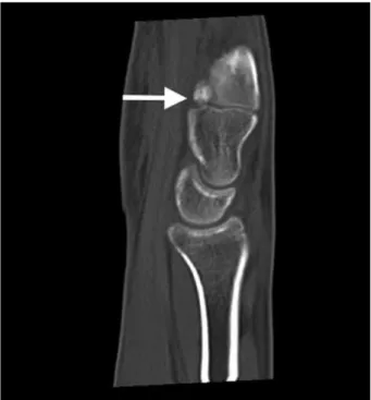 Figure 2. In the computed tomography section of the second patient,  a sclerotic lesion was observed at the proximal palmar side of the third  metacarpal