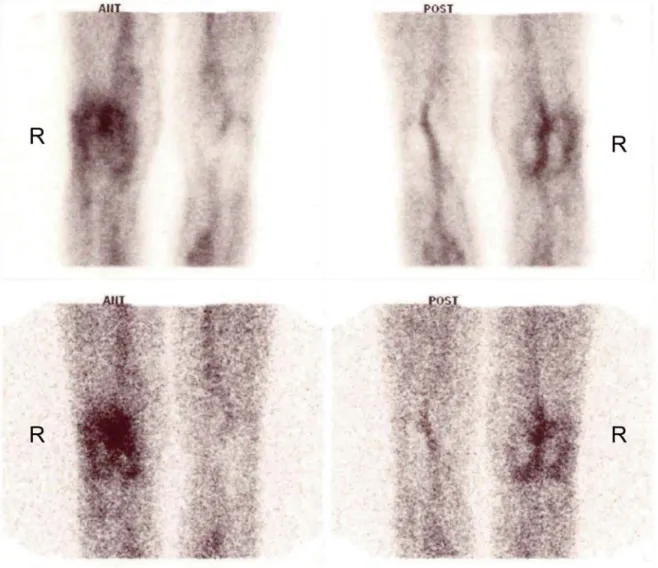 Figure 1. Anterior (left) and posterior (right) labelled leukocyte images of the patient showing increased periprosthetic activity around  right total knee replacement with  99m Tc-HMPAO-labelled leukocyte scintigraphy