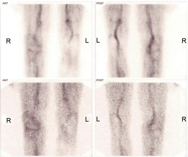 Figure 2. Anterior (left) and posterior (right) labelled leukocyte images of the patient with  99m Tc-HMPAO-labelled leukocyte scintigraphy  after 6 weeks of treatment
