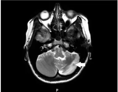 Figure 2.  T2 hyperintensity in the left posterior inferior cerebellar  hemisphere in axial magnetic resonance imaging