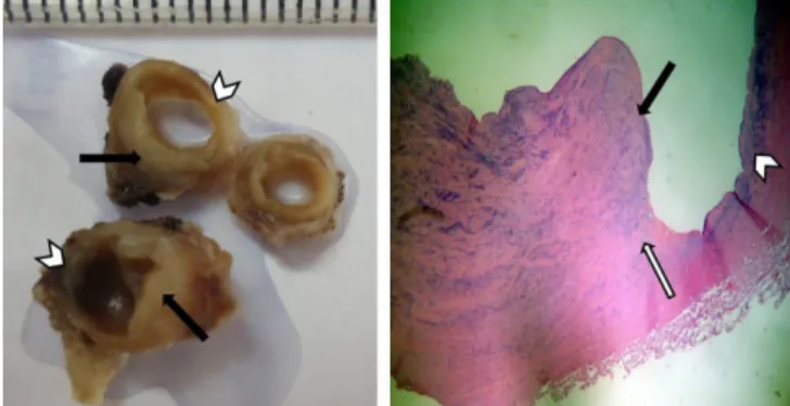 Fig. 1 -  Coarctation and saccular aneurysm formation in the  descending aorta in cardiac catheterization (left side - arrow)