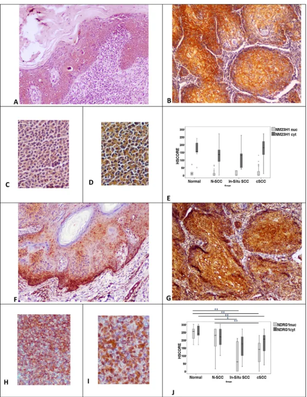 Fig. 1. NM23-H1 expression in in situ (A) and invasive carcinoma (B). Besides strong cytoplasmic expression, weak nuclear expression of NM23-H1 is occasionally detected in invasive carcinoma (B)