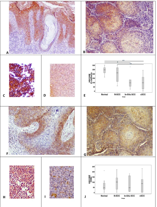 Fig. 2. Membranous E-cadherin expression in in situ (A) and invasive (B) carcinoma. The downregulation is easily detected in SCC