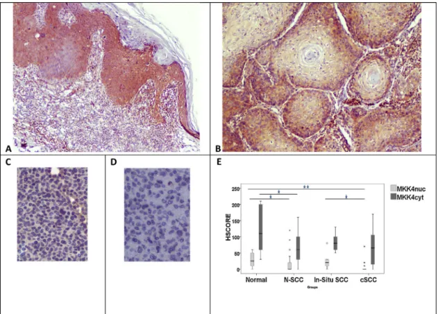 Fig. 4. MKK4 expression in in situ and invasive SCC (A, B). MKK4 cyt expression is clearly seen in in situ (A), but shows weaker staining in SCCs (B)