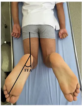 Fig. 1. Measurement of foot femur angle (FFA).