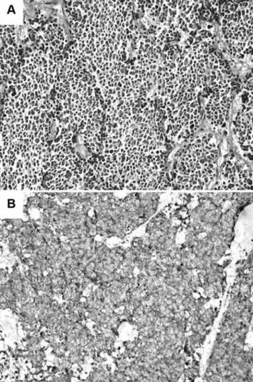 Fig. 1 - Histopathological image of small-cell carcinoma of the pa- pa-rotid gland. (a) Tumor cells forming solid nests with hyperchromatic  nuclei, inconspicuous nucleoli and scanty cytoplasm
