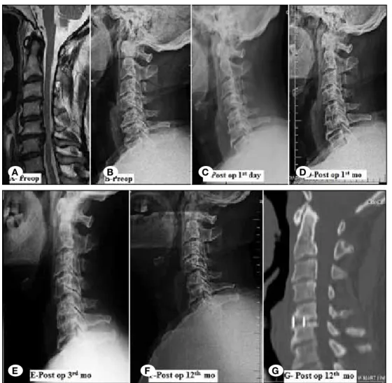 figure 2: A) preoperative MRI,  B) preoperative, postoperative  C) 1 st  day, D) 1 st , E) 3 rd  and f) 12 th months lateral plain radiograms  and G) late postoperative sagittal  CT scans of the patients (group A  and B)