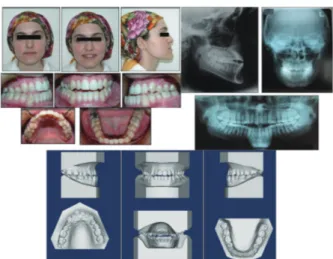 Fig. 1   Pretreatment facial and intraoral photographs, dental casts, and  lateral cephalometric, posteroanterior and panoramic radiographs.