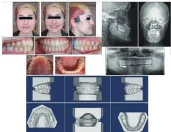 Fig. 2   Post-treatment facial and intraoral photographs, dental casts,  lateral and posteroanterior radiographs, and panoramic radiograph just  before removal of appliances.