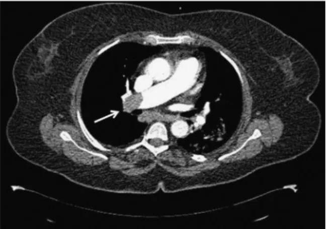 Fig. 2. Pulmonary CT angiography shows pulmonary embolism being more pro- pro-minent in the right pulmonary artery (arrow).
