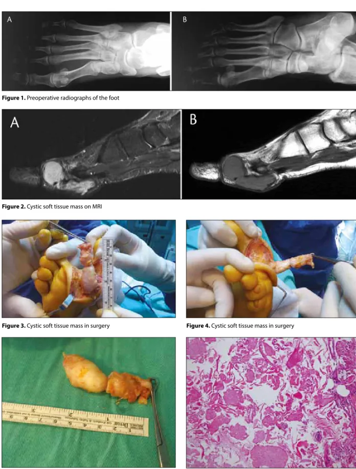 Figure 5. Excised soft tissue mass Figure 6. Cyst has a wall nearly similar to epidermis and is filled with  laminated keratin (HE, ×200)