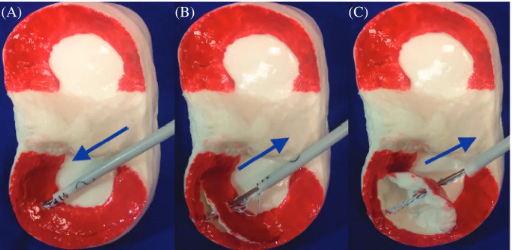 Figure 2. Application of the inside-out suture as the first suture in our hybrid technique