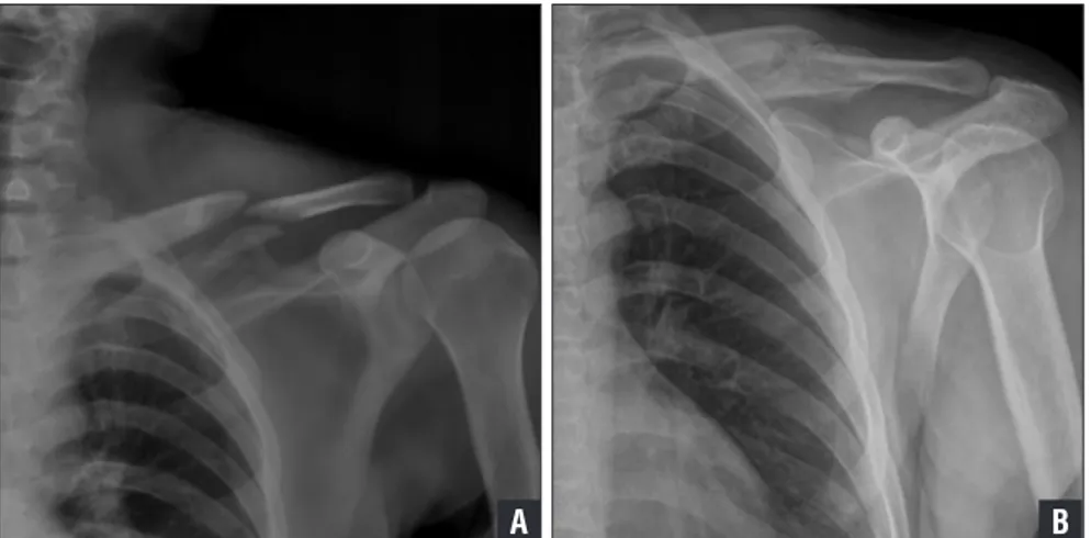 Figure 1: Anteroposterior radiographs of a left Robinson type 2B2 clavicular fracture before application of  a figure-of-eight bandage (A) and 8 months after treatment (B).