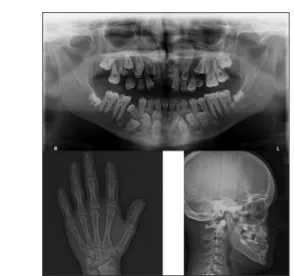 Figure 2: Multiple supernumerary teeth are observed on  orthopantomography; the hand-wrist radiography image shows  short distal phalanges in the digits; cephalometric radiography 