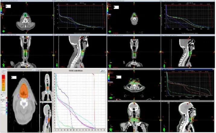 Fig. Dose distributions and dose-volume histograms of 4 planning techniques: (A) IMRT, (B) VMAT, (C) HT, and (D) 3D-CRT