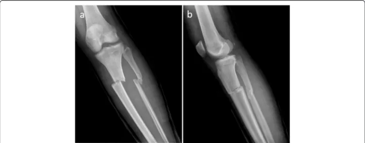 Fig. 1 a, b Twenty-eight-year-old male with a type 2 open tibia fracture. The patient was referred to us after 1 week