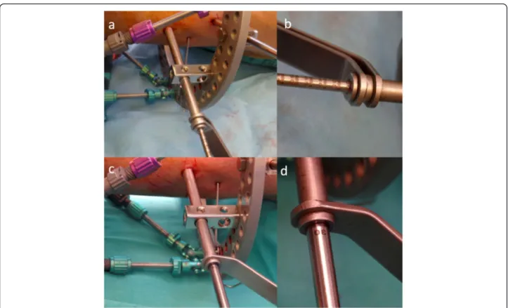 Fig. 2 Schanz sleeve (a), drill sleeve (b), drill bit (c), and Schanz screws (d) with depth measure marks