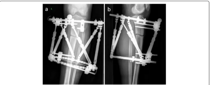 Fig. 4 a, b The postoperative third-day radiograph of the fracture after correction of the deformity