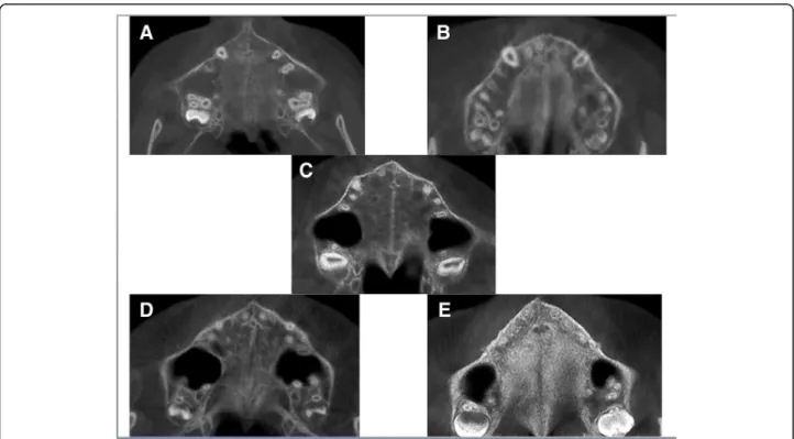 Fig. 2 The maturation stages of the midpalatal suture. a The midpalatal suture has no interdigitation