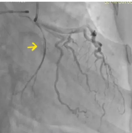 Figure 2. Right anterior oblique caudal view showing an occurrence of  no-reflow in the circumflex artery (arrows).