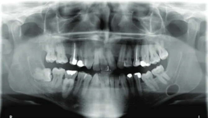 Figure 1: Panoramic radiography showing the radiolucent area.