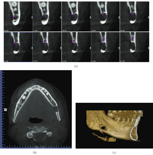 Figure 2: CBCT images: (a) sagital view displaying continuous 1 mm width sections, (b) horizontal view displaying the cavity outline with diminished buccal cortical bone, and (c) 3D reconstruction of the left mandible displaying buccal cortical bone reduct