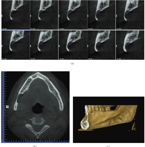 Figure 4: CBCT images: (a) sagital view displaying continuous 1 mm width sections, (b) horizontal view displaying the cavity outline, and (c) 3D reconstruction of the right mandible displaying buccal cortical bone reduction.