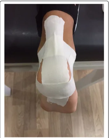 Fig. 1 Kinesio taping treatment applied to the Achilles tendon and heel region