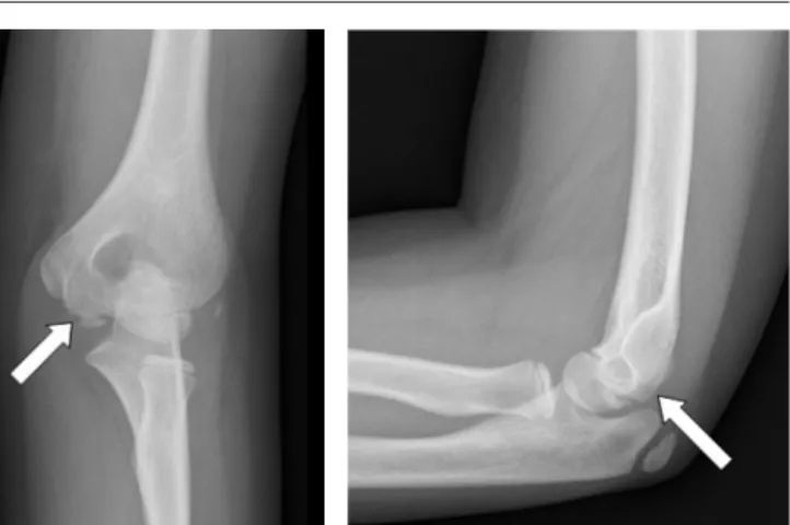 Figure 1. AP and lateral views of right elbow showing a slight radiolucent defect  in the trochlear notch (A, B).