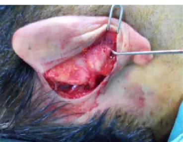 Figure 2. Skin hook is in then arrow tunnel under the pericondrium above  the anti helical fold 
