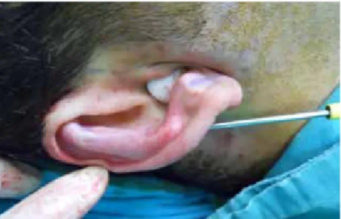 Figure 3. Passage of skin hook through the incision at the junction of  the anti helix  and antitragus  in a lateral manner