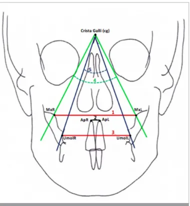 Figure 3. Maxillary skeletal measurements: 6: A-Ver (distance between point A and vertical reference plane), 7: ANS-Ver (distance between  anterior nasal spine and vertical reference plane), 8: SNA (posteroinferior angle between anterior cranial base and n