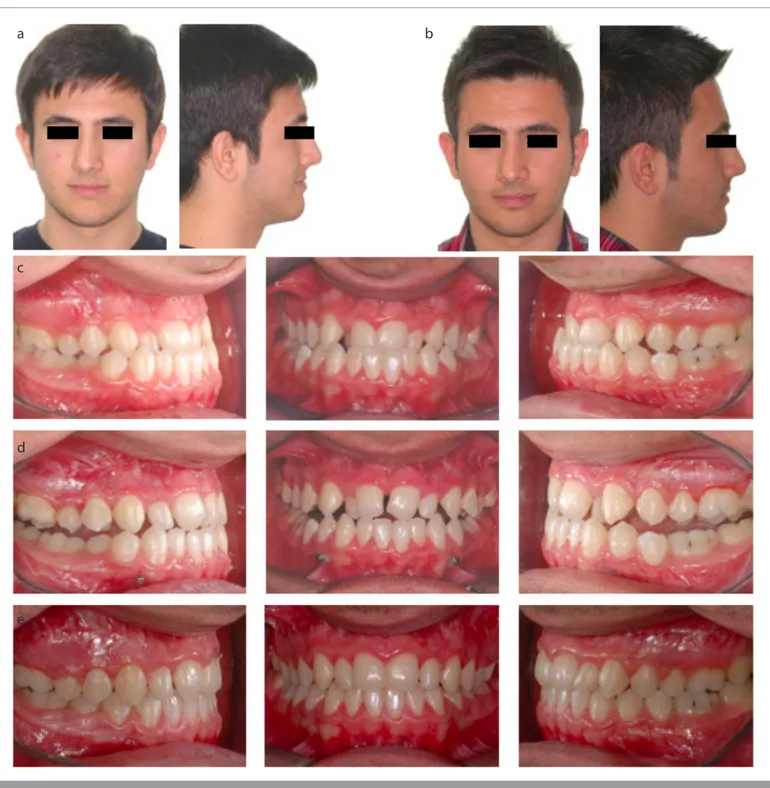 Figure 4. a-e. Photos of a patient treated with SARME/intermaxillary Class III elastic procedure and fixed orthodontic treatment