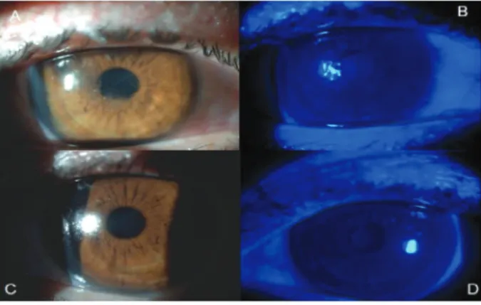 Figure 1 - Optical coherence tomography images from patient No. 12’s  right eye (laser-assisted sub-epithelial keratectomy [LASEK])  showing: A) at the first hour of surgery over central cornea  vertex, showing LASEK flap under therapeutic contact lenses  