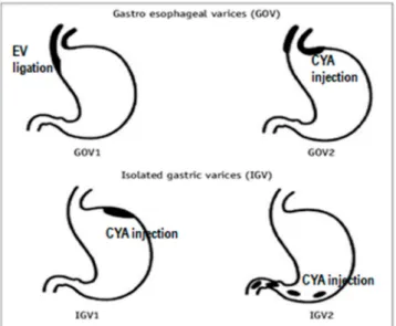 Figure 1. Treatments recommended for gastric varices according to Sarin classification;