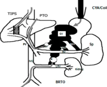 Figure 4. Basic porto-systemic venous anatomy of GV with the shunts and treatment modalities;