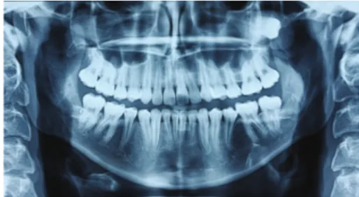 Figure 1: A panoramic radiograph revealed that the left maxillary third molar was displaced in a posterosuperior direction.