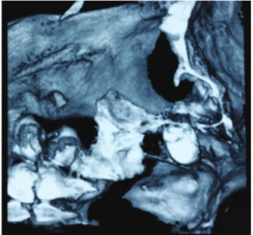 Figure 3: CT revealed that the root was stuck in the antrum of pterygopalatine fossa.